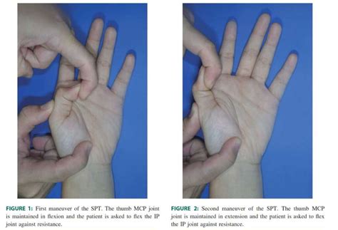 sesamoid bone thumb pain